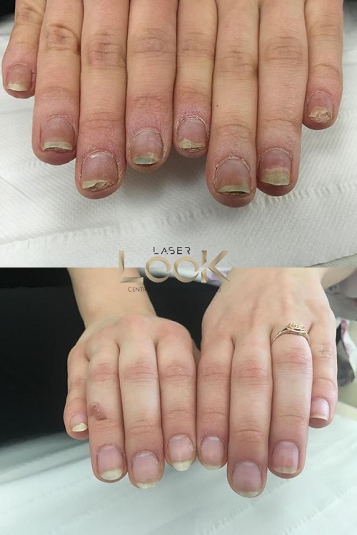 Grzybica przed i po leczeniu